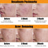 TEA TREE - Serum Acne Removal